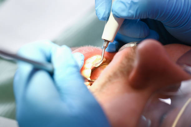 Best Emergency Wisdom Teeth Removal in Jackson, KY