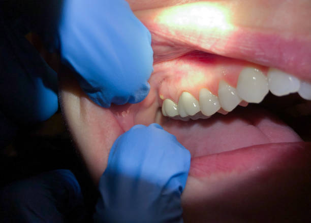 Best Emergency Tooth Extraction in Jackson, KY