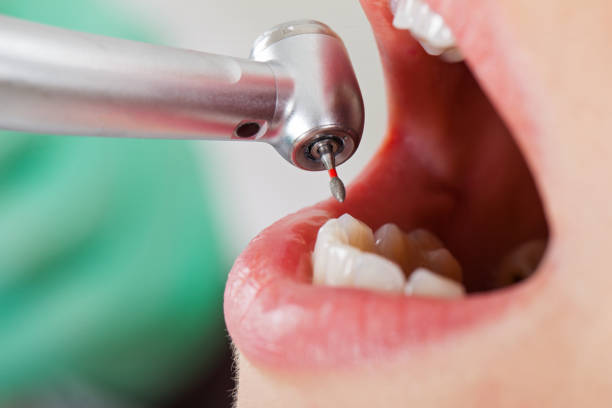 Best Emergency Root Canal Treatment in Jackson, KY
